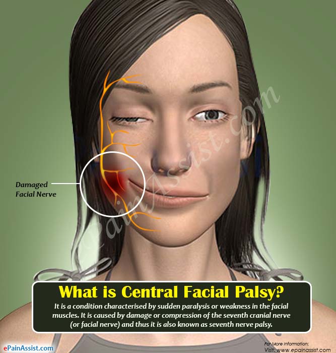 Dollface reccomend Facial nerve droopy mouth