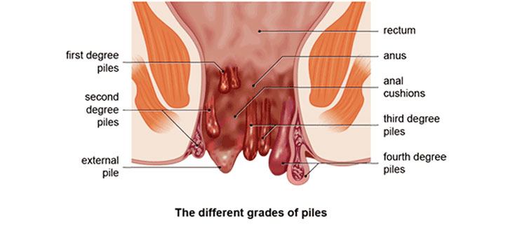 Fisure in anus