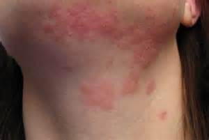Anal seepage rash