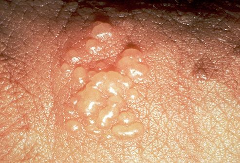 Clusters of itchy bumps on vagina