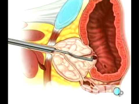 Surgery sexual organ video