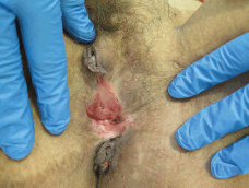 best of Vulva lesion cell Squamous