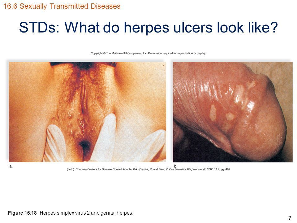 best of In your Can herpes vagina be