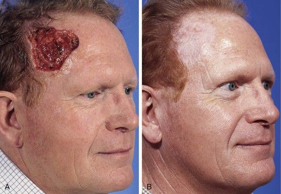 Facial skin grafting surgery