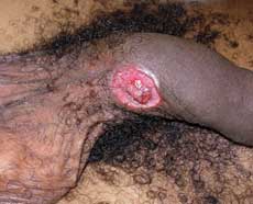Skin lesion on penis