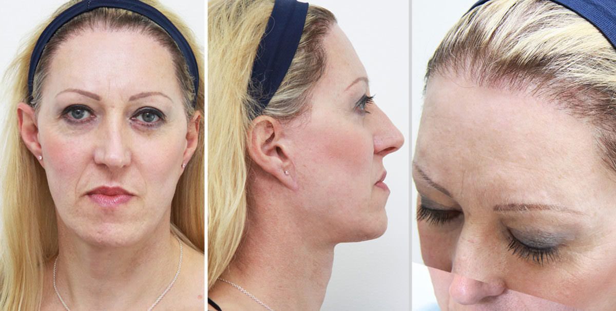 Facial feminisation surgery