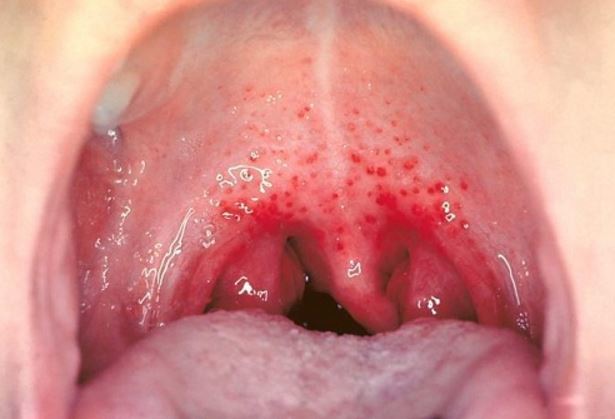 Oral sex red spots in throat