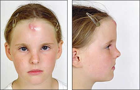 Cyst facial swelling