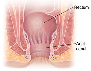 Stenosis of the anal canal