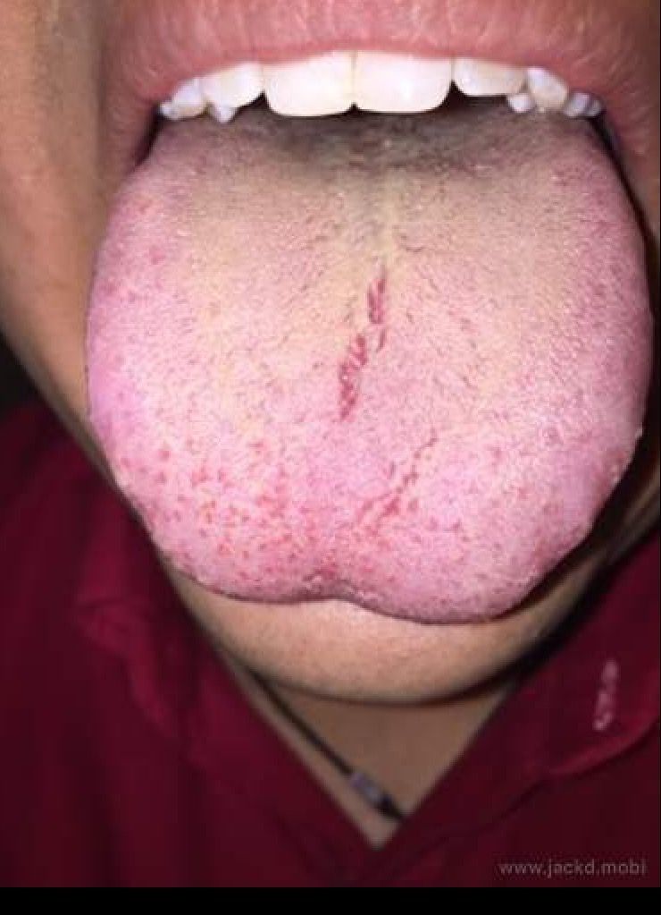 best of Throat After sore oral sex