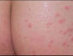 best of Of bumps on vagina Clusters itchy