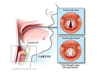 Laryngeal vocal cord vibrator