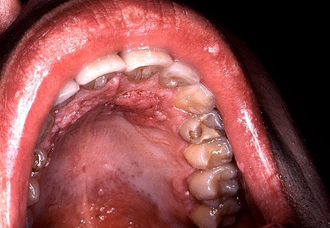 best of Sex in throat red spots Oral