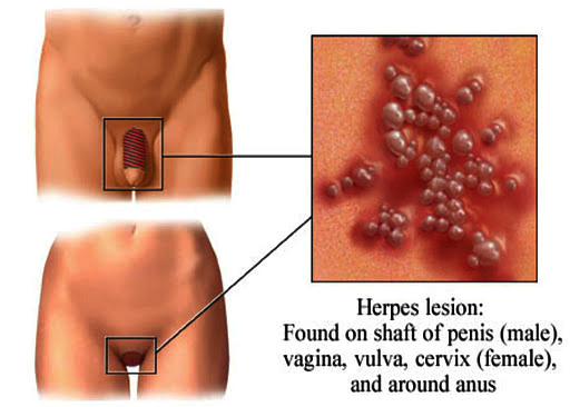 Can herpes be in your vagina