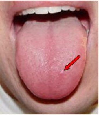 best of And sore throat Burning tongue