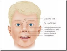Abbot reccomend Facial characteristics of williams syndrome