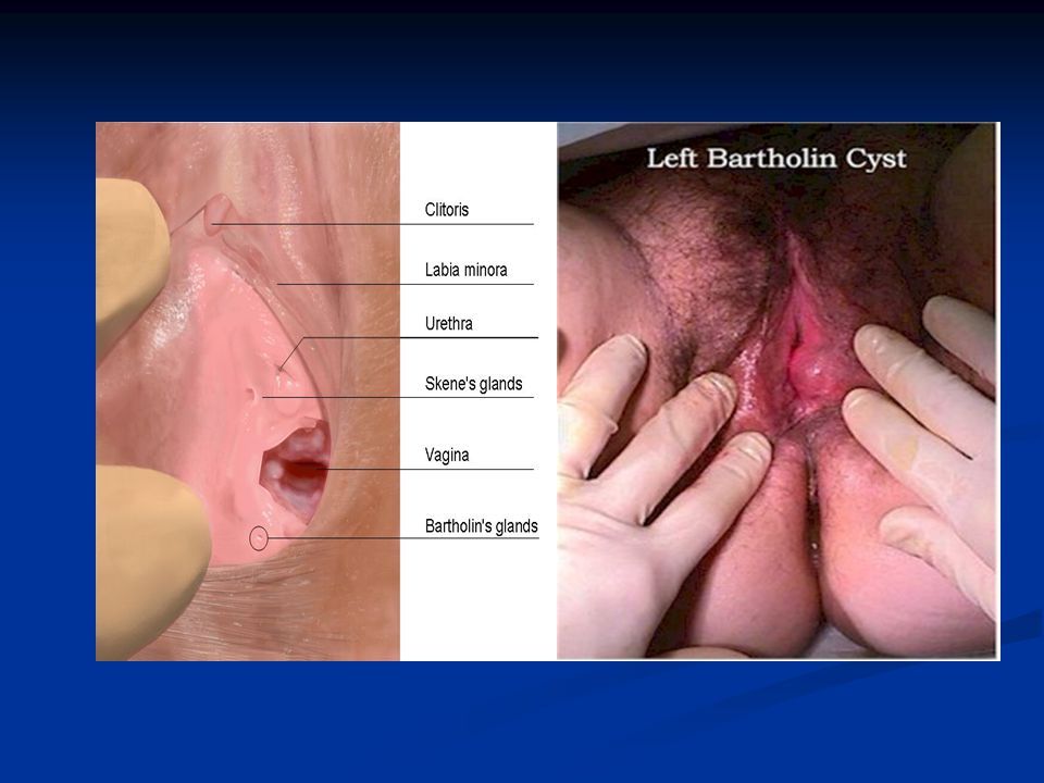 best of Clitoris Cyst beside