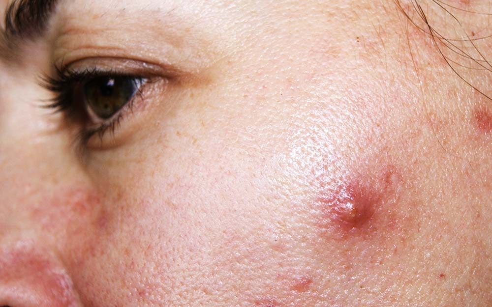 The E. Q. reccomend Cyst facial swelling