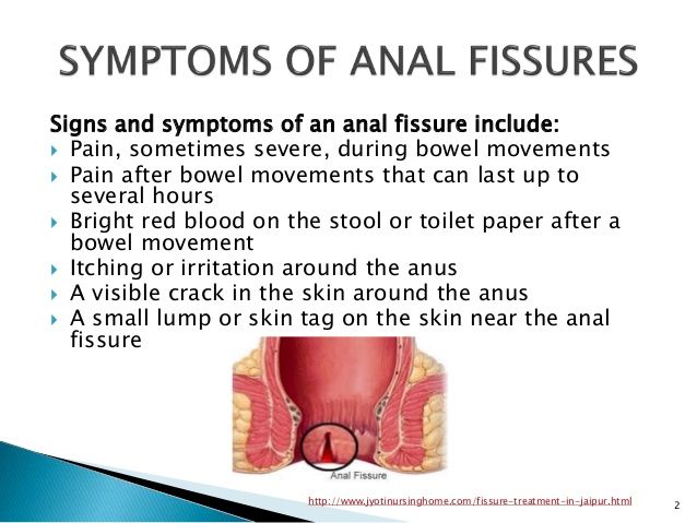 Anal fissure treatments