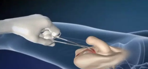 Surgery sexual organ video