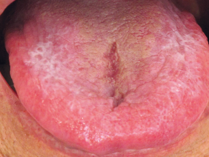 best of And sore throat Burning tongue