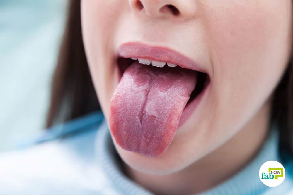 Polka-Dot reccomend Burning tongue and sore throat
