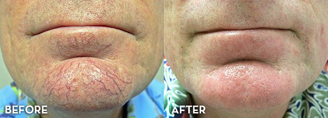 Chardonnay reccomend Treatments for spider veins facial