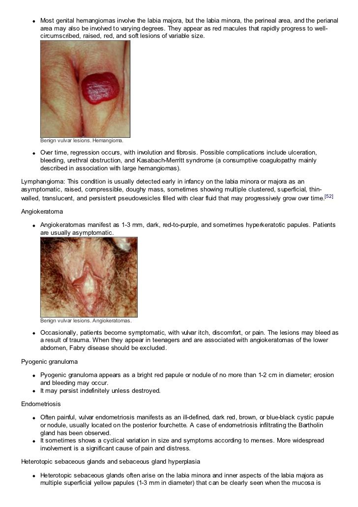 Deck reccomend Type c vulva lesion