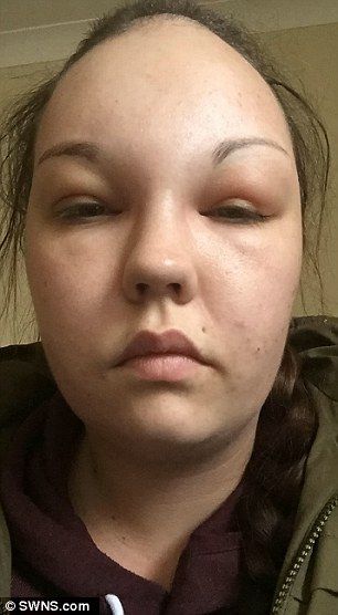 Alien reccomend Cyst facial swelling