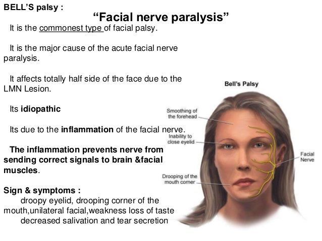 Facial paralysis due to nerve damage