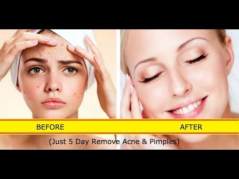 Lights O. reccomend Facial acne home remedies