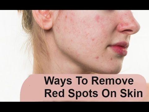 best of 2018 How Caused FuckBook By To Redness Reduce Naked Acne