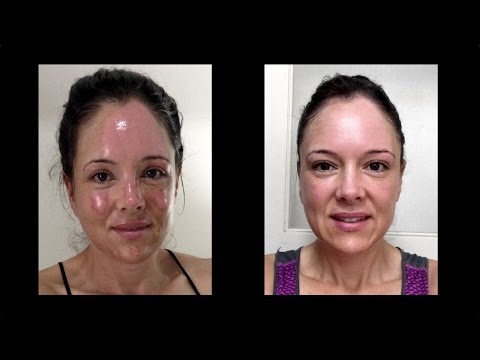 Facial burn healing remedies