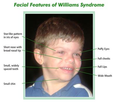 Queen C. reccomend Facial characteristics of williams syndrome