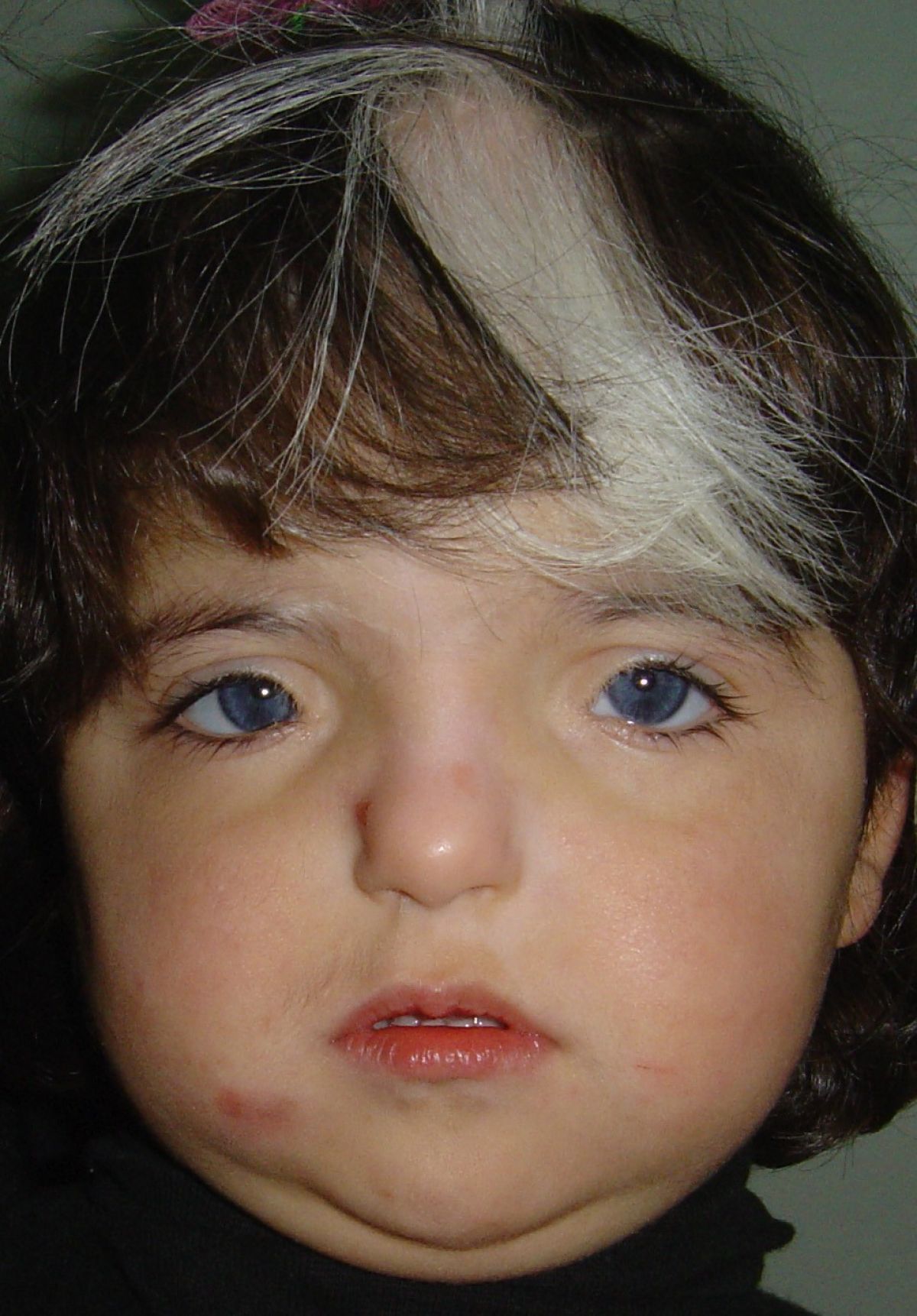 best of Syndrome Facial waardenburg features of