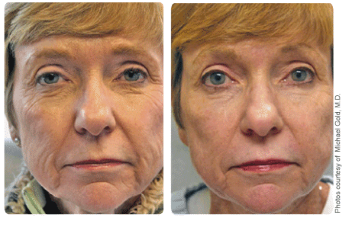 Facial line reduction