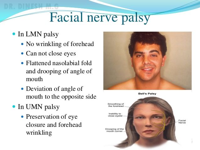 Facial nerve weakness