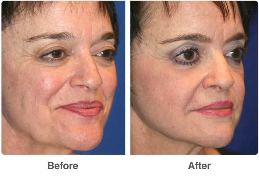 best of Grafting surgery skin Facial