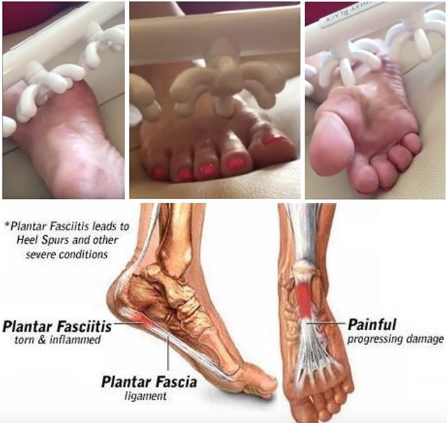 Hot B. reccomend Foot bottom pain diagnosis