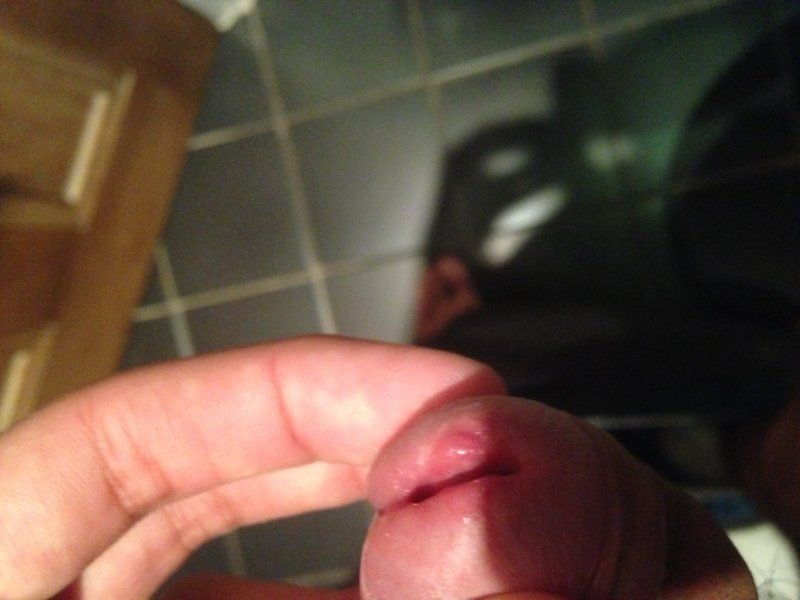 Hole in side of penis