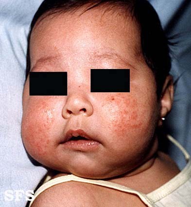 Infant facial eczema