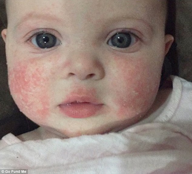 Golden G. reccomend Infant facial eczema