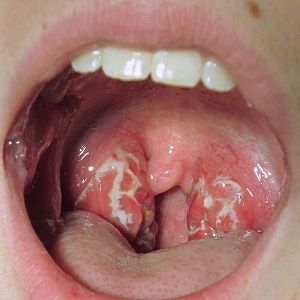 Bass reccomend Oral sex red spots in throat