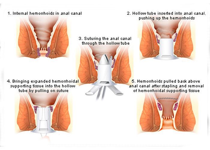 Stenosis of the anal canal