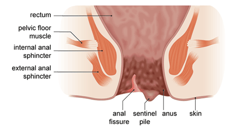 Sunshine reccomend Stenosis of the anal canal