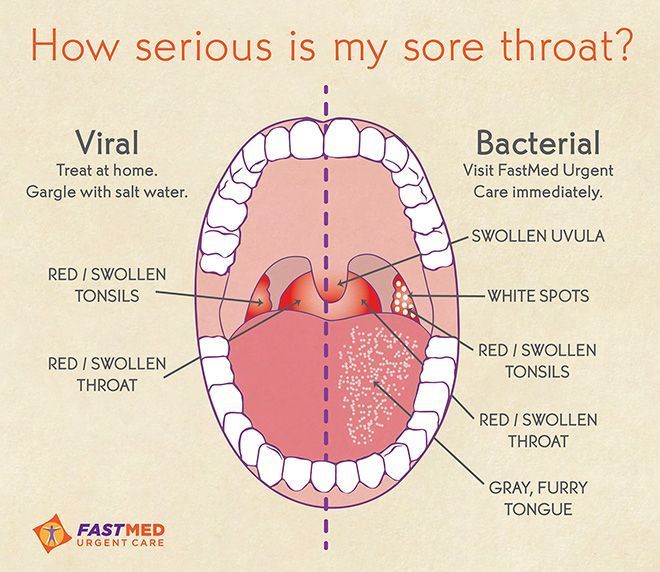 Scratch reccomend Strep throat stomach pain adults