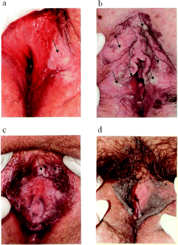 best of C lesion Type vulva